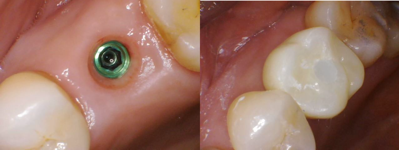 Single Tooth Implants