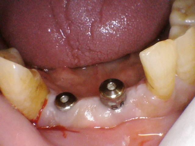 Implant Supported Bridges