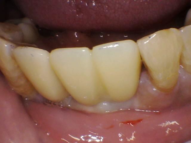 Bone Grafting