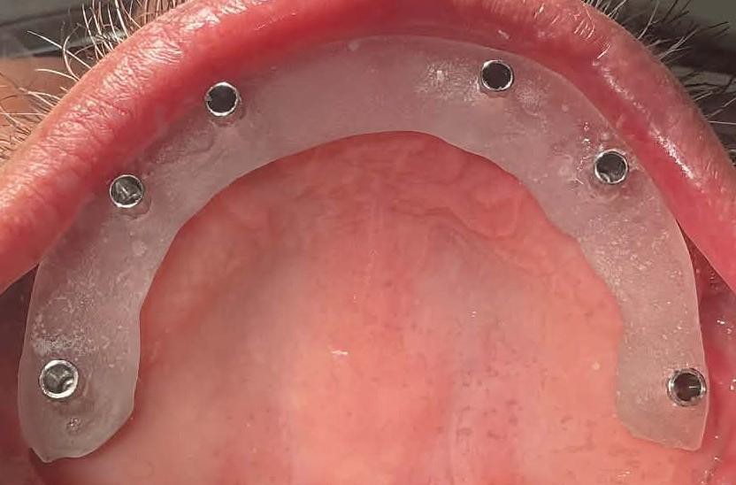 Guided Implant Surgery