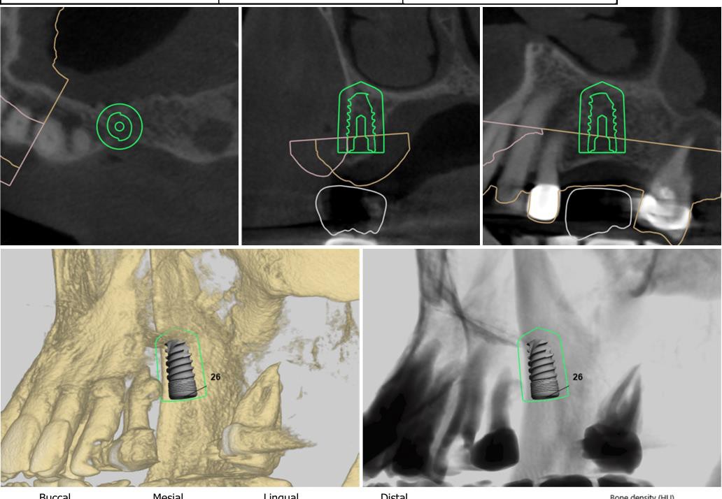 Complex Implant Treatment